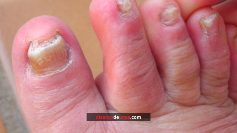 Diseños de uñas ¡1.000 ideas en imágenes! 21 Hongos en las uñas de los pies