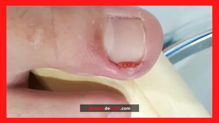 Diseños de uñas ¡1.000 ideas en imágenes! 23 Qué es una uña encarnada