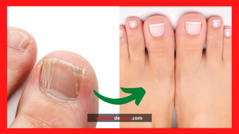 Diseños de uñas ¡1.000 ideas en imágenes! 25 consejos para deshacerse de los Hongos en las uñas de los pies